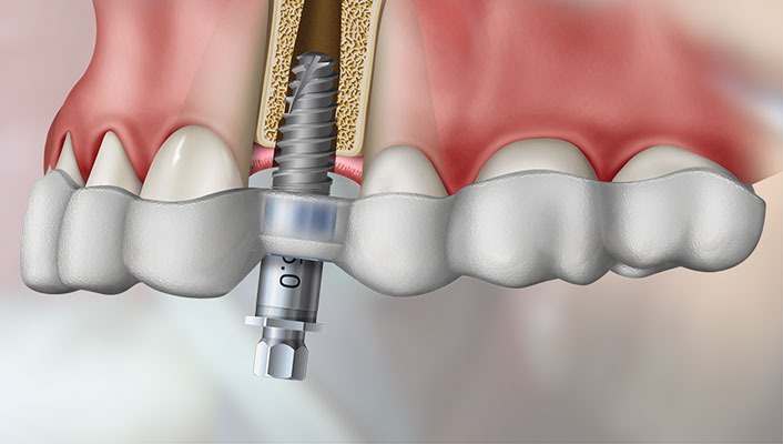 Planejamento virtual e cirurgia guiada para implantes dentários
